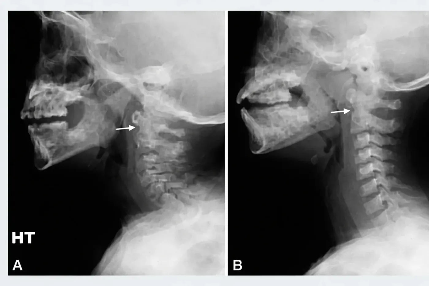 Cervical alignment for migraine relief and clear mornings